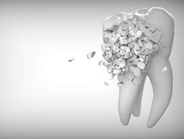 hvad koster en tandblegning og hvorfor